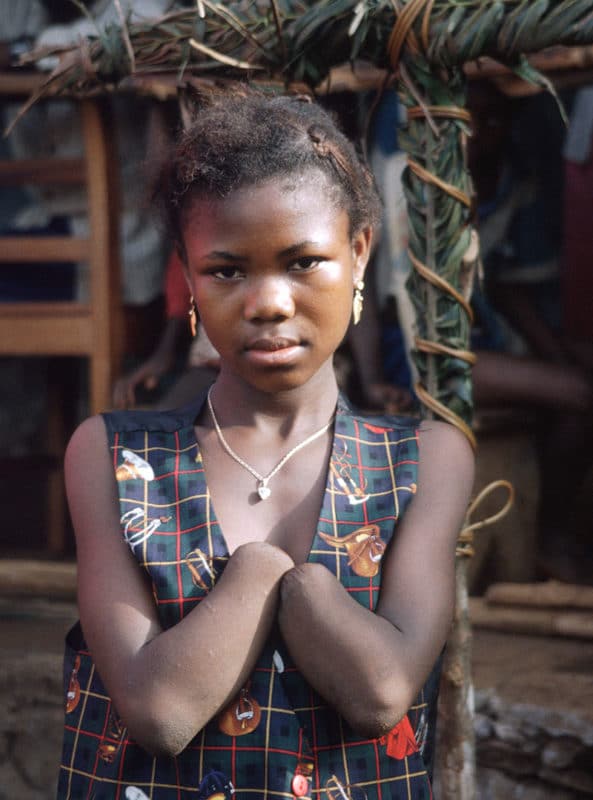 Fra en leir for amputerte i Sierra Leon. Bildet er av et barn uten hender.